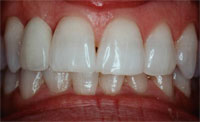 dental implant after