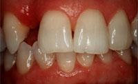 dental implant before