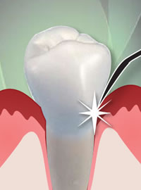 laser periodontics